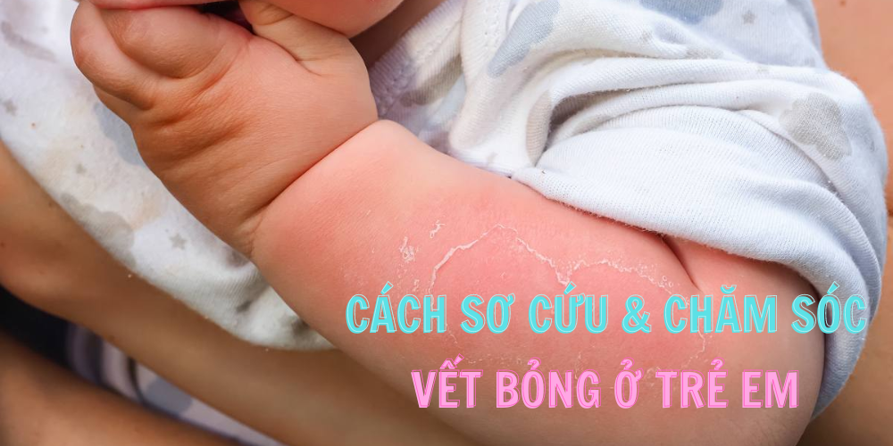 Trẻ bị bỏng: Cách sơ cứu và chăm sóc vết bỏng an toàn