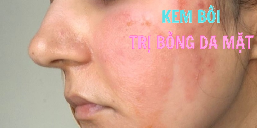 Kem Trị Bỏng Dành Cho Da Mặt Tốt Nhất Hiện Nay