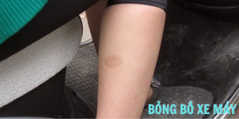 Bỏng bô xe máy thì nên bôi gì