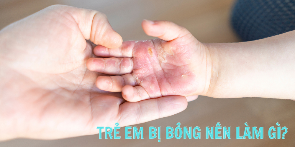 Bé bị bỏng thì nên làm gì